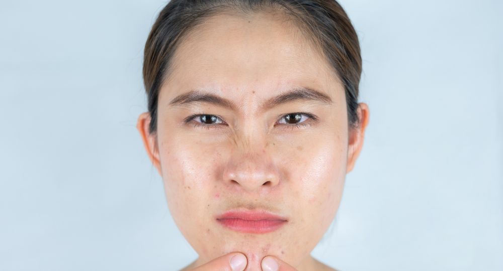 Say Goodbye to Blackhead Problems: Effective Removal Tips and Techniques